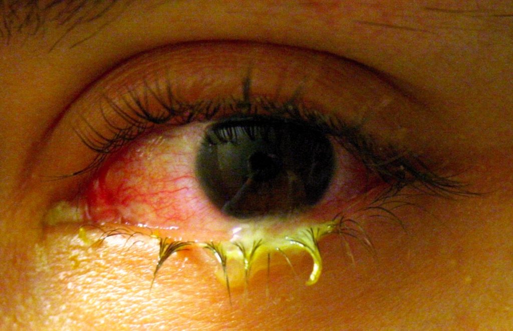 “Swollen eye with conjunctivitis.jpg” by Tanalai at English Wikipedia is licensed under CC BY 3.0 Photo showing closeup of eye infected with conjunctivitis