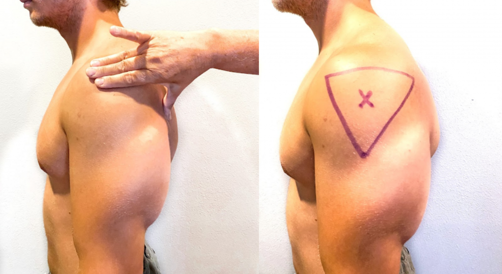 “Injecting Site Image 3.jpg” and "Injection Site Image 2.jpg" by Meredith Pomietlo for Chippewa Valley Technical College are licensed under CC BY 4.0. Photo showing the location of the deltoid injection site