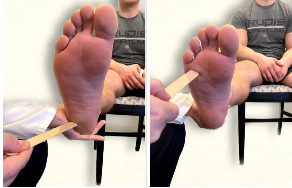 "Neuro Exam Image 23.png" and "Neuro Exam image 21.png" by Meredith Pomietlo for Chippewa Valley Technical College is licensed under CC BY 4.0 Photo showing plantar reflex in two positions