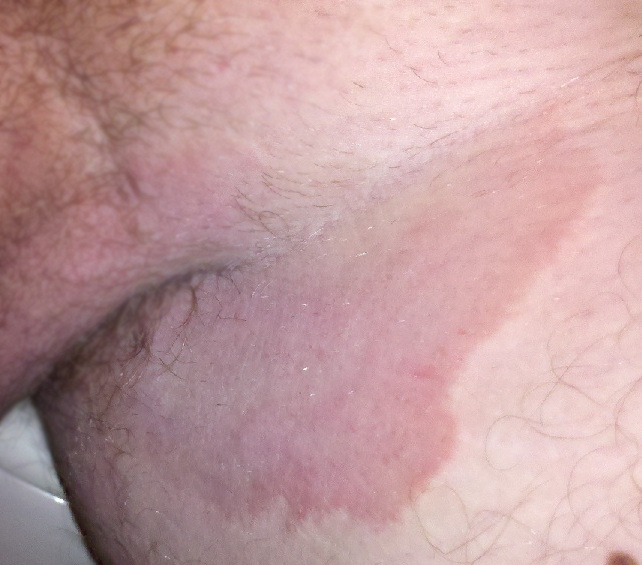 “Tinea cruris.jpg” by Robertgascoin is licensed under CC BY-SA 3.0 Photo showing fungal infection in the groin of a male