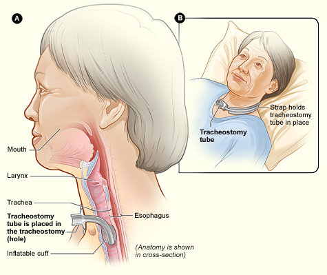 “Tracheostomy NIH.jpg” by National Heart Lung and Blood Institute (NIH) is in the Public Domain Illustration showing patient with tracheostomy tube from two angles