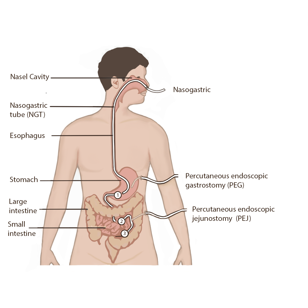 “Types and Placement of Enteral Tubes” by Meredith Pomietlo for Chippewa Valley Technical College is licensed under CC BY 4.0 Illustration showing Types and Placement of Enteral Tubes