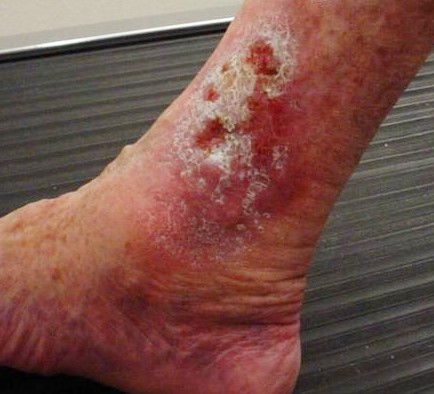 “Úlceras_antes_da_cirurgia.JPG” by Nini00 is licensed under CC BY-SA 3.0 Photo showing closeup of skin damage on lower leg due to venous ulcer