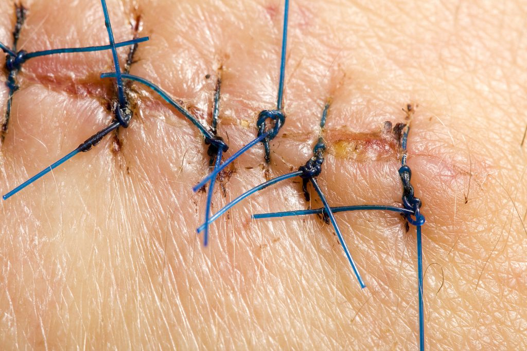 “Wound closed with surgical sutures.jpg” by Wikip2011 is licensed under CC BY-SA 3.0 Photo showing closeup of healing sutures