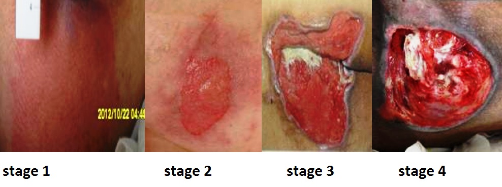 “ Would stage.jpg” by Babagolzadeh is licensed under CC BY-SA 3.0 Photo showing four stages of pressure wounds
