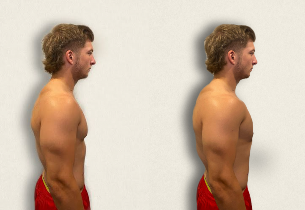 “Normal A-P Chest Image.jpg" and "Barrel Chest.jpg" by Meredith Pomietlo for Chippewa Valley Technical College is licensed under CC BY 4.0 Photo showing a side view of normal and barrel chest appearance of simulated patient
