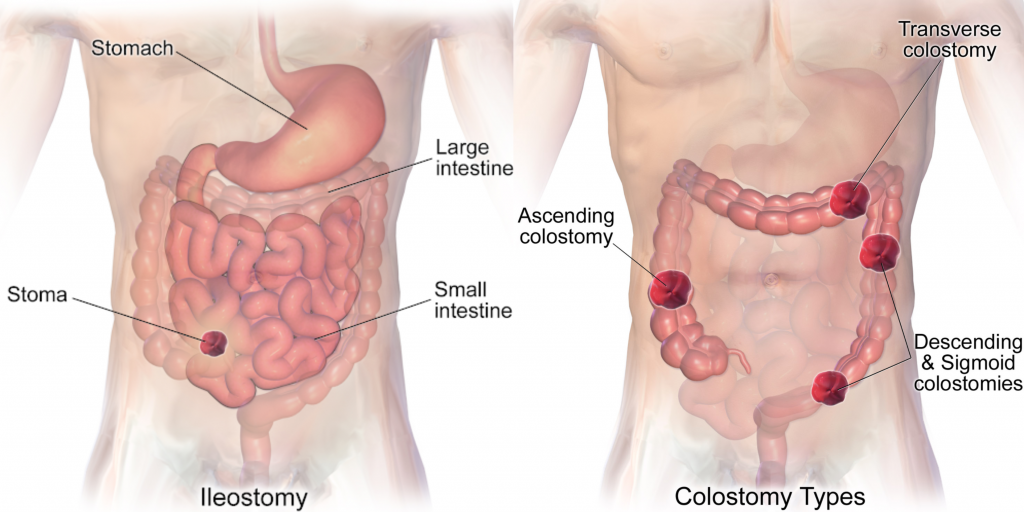 ”Ileostomy.png” by BruceBlaus is licensed under CC BY-SA 4.0 and “Blausen_0247_Colostomy.png” by CC BY 3.0 Illustration showing Location of an Ileostomy Compared to Colostomies
