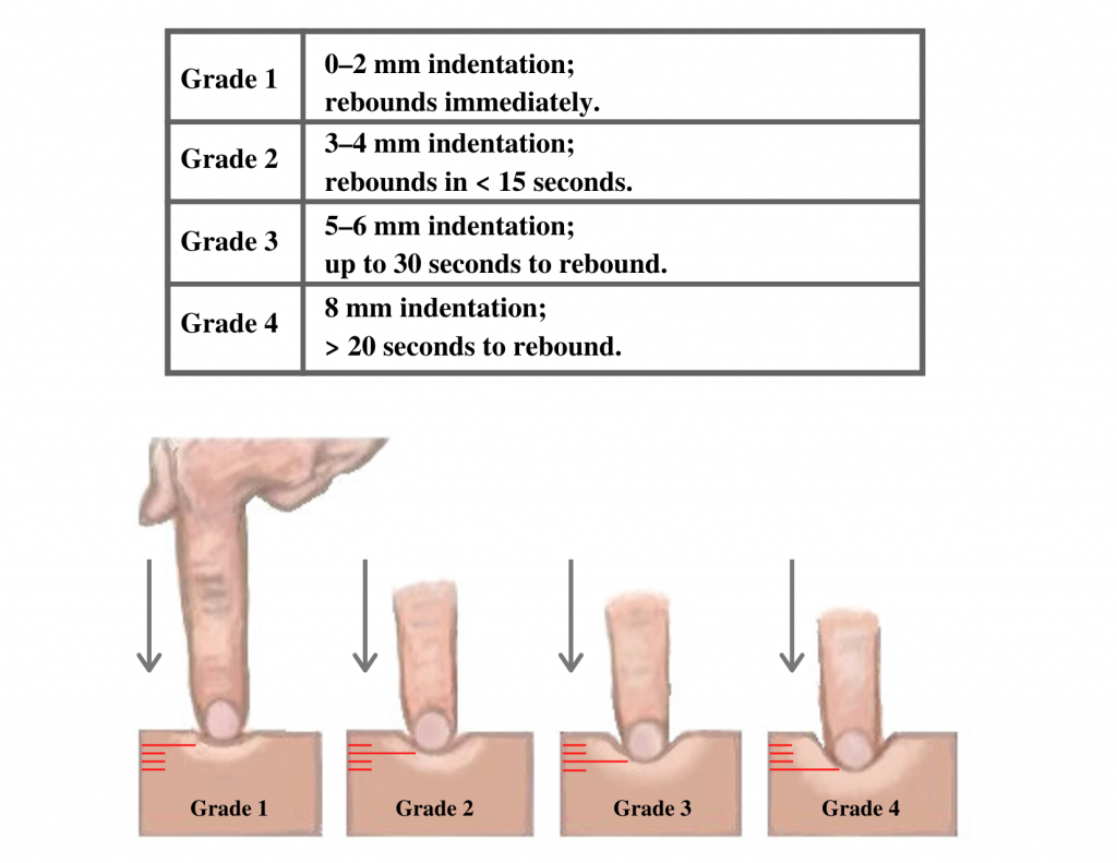 “Grading of Edema” by Meredith Pomietlo for Chippewa Valley Technical College is licensed under CC BY 4.0 Textual graph and picture showing grades one through four of pitting edema