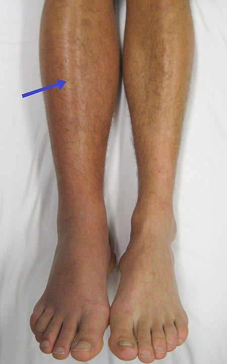 “Deep vein thrombosis of the right leg.jpg” by James Heilman, MD is licensed under CC BY-SA 3.0 Photo showing deep vein thrombosis