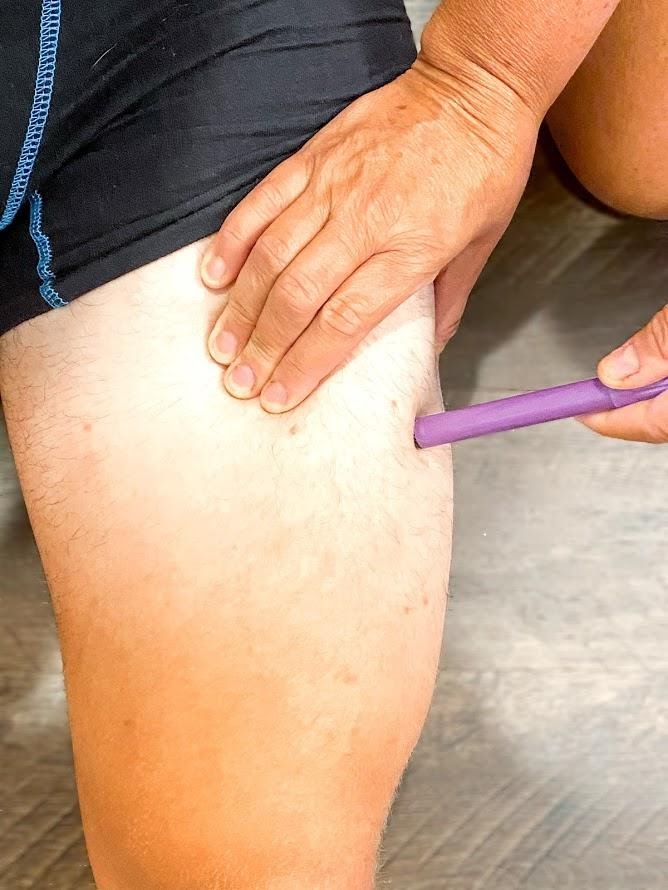 “Intramuscular Injection at Vastus Lateralis Site” Meredith Pomietlo for Chippewa Valley Technical College is licensed under CC BY 4.0 Photo showing Intramuscular Injection at Vastus Lateralis Site