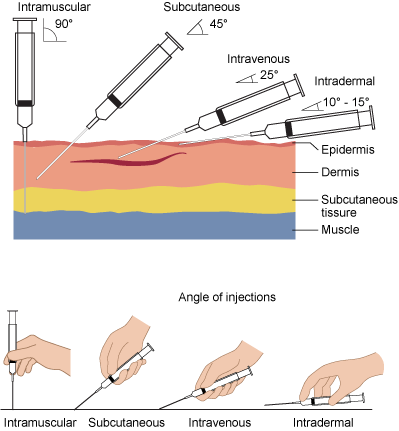 “Needle-insertion-angles-1.png” by British Columbia Institute of Technology (BCIT) is licensed under CC BY 4.0. Access for free at https://opentextbc.ca/clinicalskills/chapter/safe-injection-administration-and-preparing-medication-from-ampules-and-vials/ Illustration showing angles of insertion for needle injections