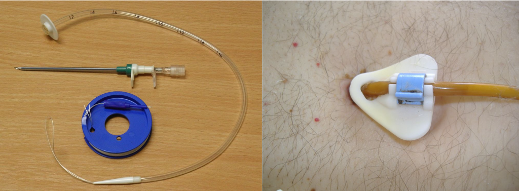 “PEG_tube_kit.jpg” by Gilo1969 and “Percutaneous_endoscopic_gastrostomy-tube.jpg” by Pflegewiki-User HoRaMi are licensed under CC BY-SA 3.0 Photo showing P E G Tube both before and during use