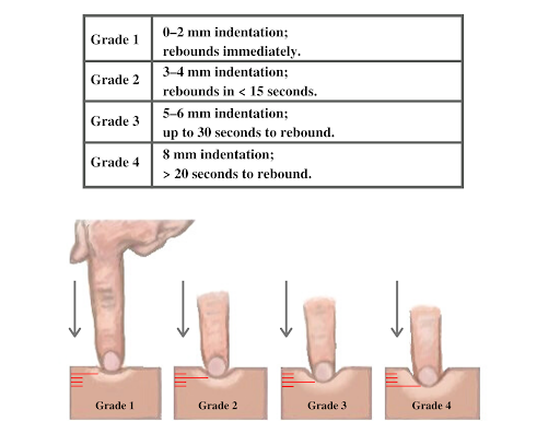 “"Grading of Edema” by Meredith Pomietlo for Chippewa Valley Technical College is licensed under CC BY 4.0 Illustration showing the grading of edema with a finger pressing into skin