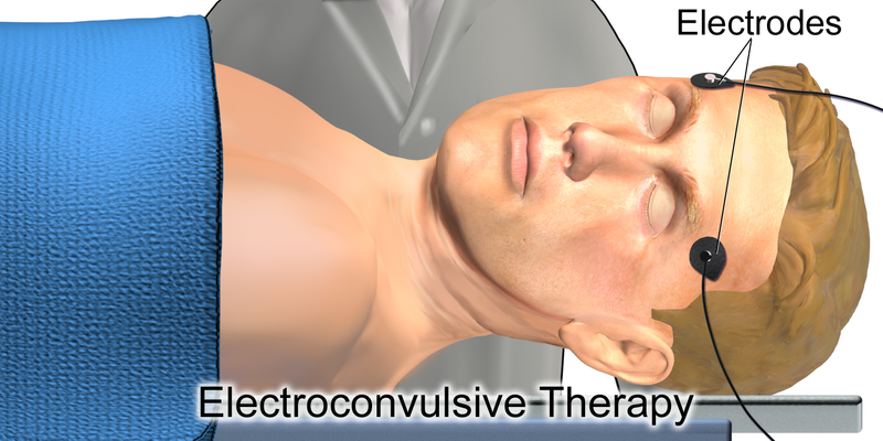 "Electroconvulsive_Therapy.png" by BruceBlaus is licensed under CC BY-SA 4.0 Illustration showing placement of electrodes on patient for electroconvulsive therapy