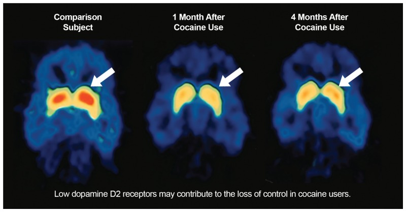 Substance Abuse and Mental Health Services Administration, & Office of the Surgeon General. (2016). Facing addiction in America: The surgeon general's report on alcohol, drugs, and health. United States Department of Health and Human Services. Used under Fair Use. https://www.ncbi.nlm.nih.gov/books/NBK424857/ Image showing Decreased Dopamine Receptors in an Individual With a Cocaine Addiction across several months of use