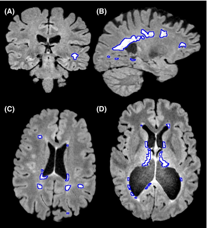 MRI images showing white hyperintensities in different areas of the brain of an individual experiencing symptoms of multiple sclerosis. (A) A coronal slice showing a lesion in peripheral white matter. (B) A sagittal slice showing large periventricular lesions. (C) An axial slice showing both periventricular and peripheral white matter lesions. (D) A case where severe atrophy caused midline false positives to not be removed, as they were further from midline than expected.