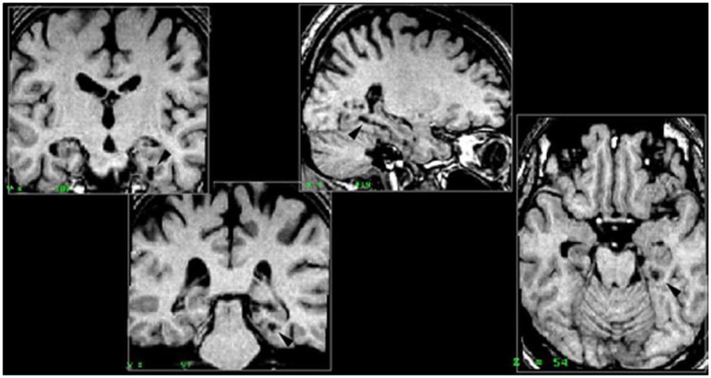 Several different MRI cross sections of a brain, showing a black (empty) region running through the temporal lobe underneath the hippocampus.